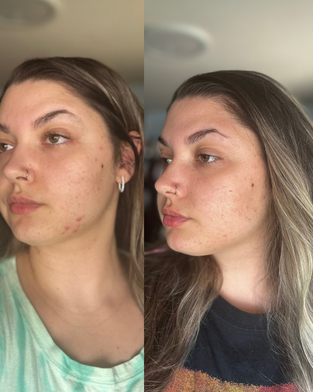 Before and after 30-day results using Adapto Beauty Barrier Support Dream Cream, showing improved hydration, less acne, smoother skin, and reduced redness and fine lines.