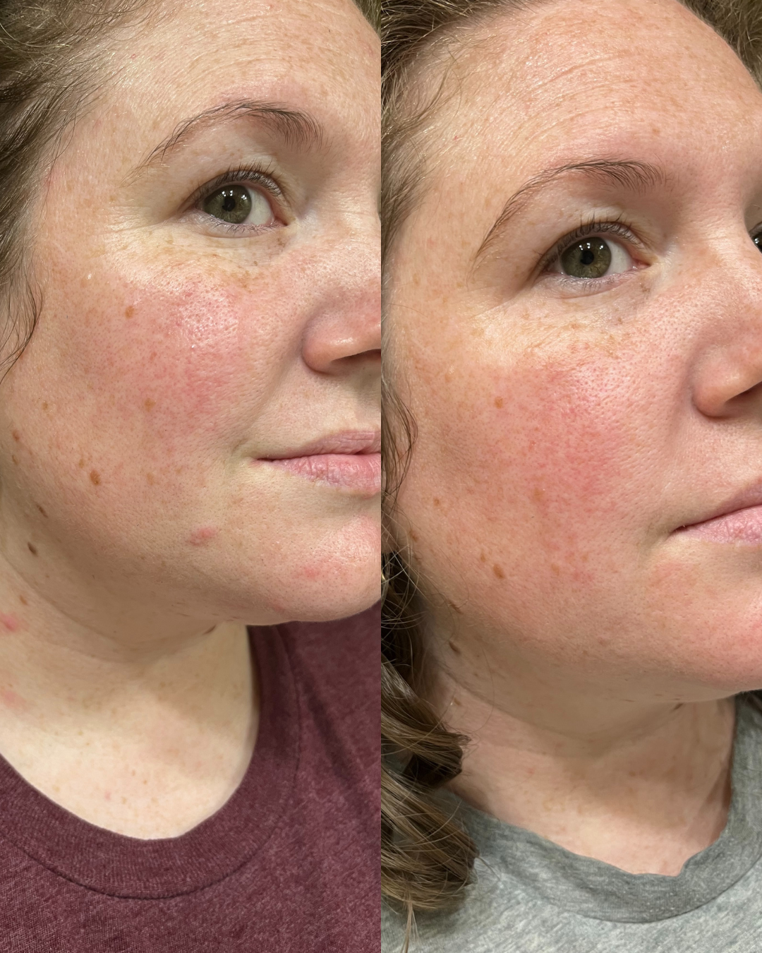 Before and after 30-day results using Adapto Beauty Barrier Support Dream Cream, showing improved hydration, smoother skin, and reduced redness and fine lines.